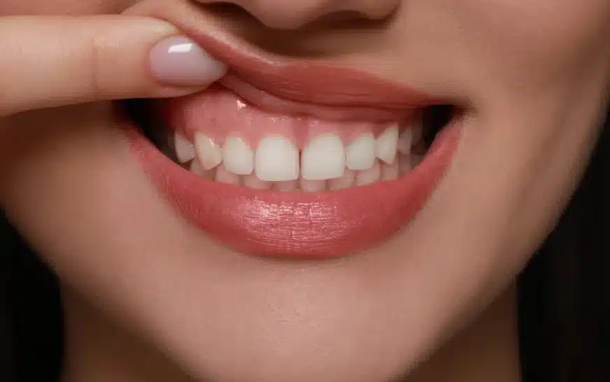 How to Cure Gum Disease Without a Dentist