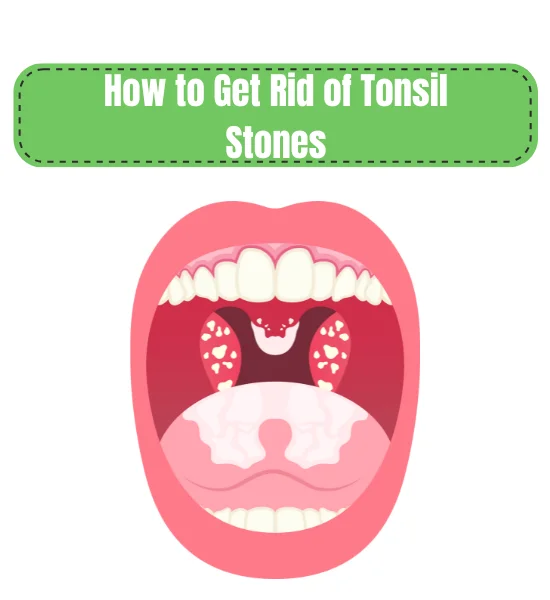 How to Get Rid of Tonsil Stones: Removal, Causes, & Symptoms